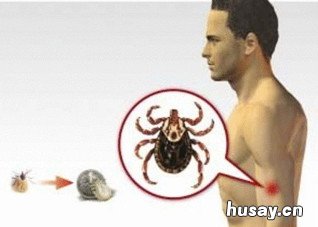 羌虫病要怎么办 恙虫病的治疗