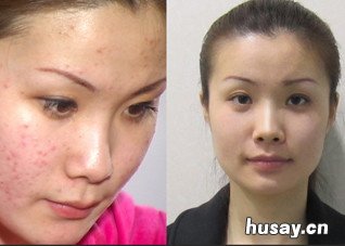 摆脱青春痘 青春痘自然消除