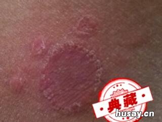 大腿内侧痒是什么病啊?最近痒得厉害总想抓? 大腿内侧痒是什么病啊女性