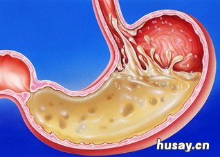 胃酸恶心怎么处理 胃酸反胃恶心