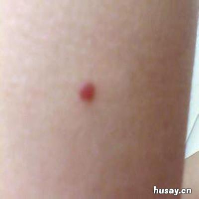 血管痣怎么办 血管痣要怎么才能去除