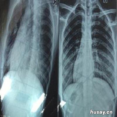 肋骨骨折多久能好 左侧肋骨骨折多久能好