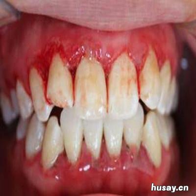 女性牙龈出血怎么办 女性牙龈出血是何病的征兆