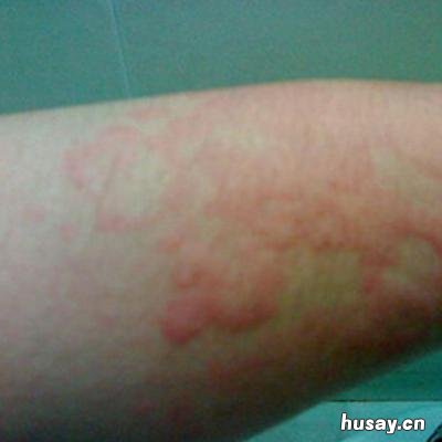 小儿丘疹性寻麻疹怎么治疗 小孩丘疹性寻麻疹