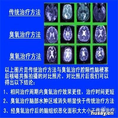 多发性脑梗塞宜吃些什么 多发性脑梗塞宜吃些什么药