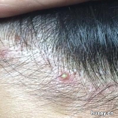 头皮毛囊炎怎么根治 头皮毛囊炎根治经验