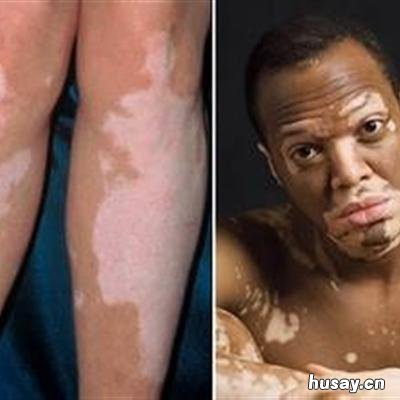 白癜风遗传的几率有多大