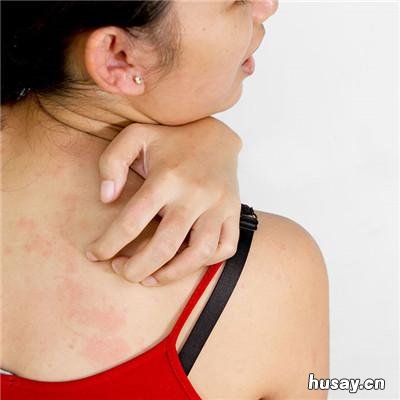 皮肤过敏怎么止痒 皮肤过敏怎么止痒见效最快