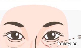 泪沟应该怎么消除 泪沟怎么消除按摩手法视频