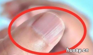 指甲上为什么有竖纹 指甲上为什么有竖纹?