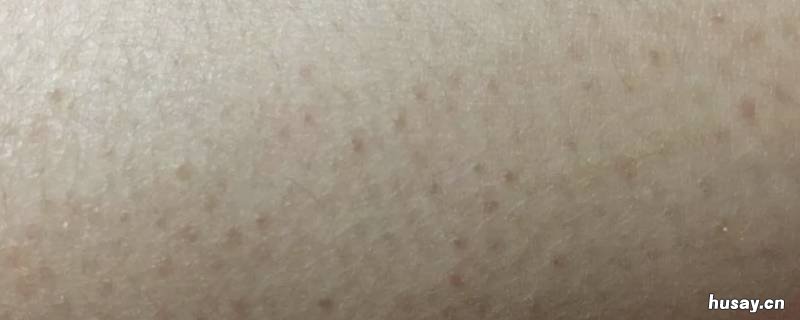 鸡皮肤怎么消除才有效 鸡皮肤怎样消除