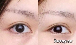 先天黑眼圈是怎么来的 先天性黑眼圈是怎么回事