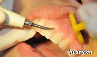 拔牙后多久可以刷牙 拔牙后多久可以刷牙和漱口