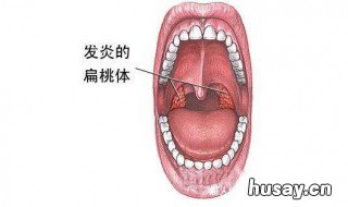 扁桃体发炎怎么办最简单的方法