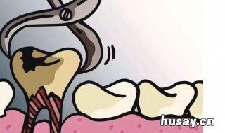 梦见拔牙预示着什么 梦到拔牙预示着什么